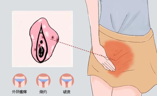 外阴瘙痒夜间加重是为什么