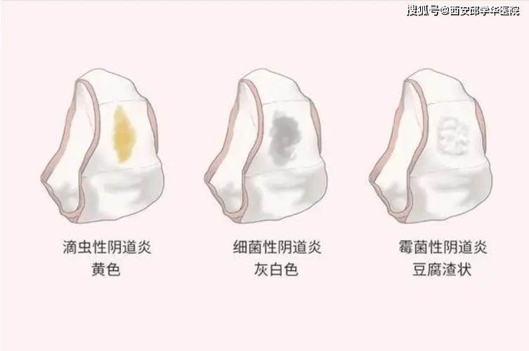 外阴瘙痒夜间加重是为什么