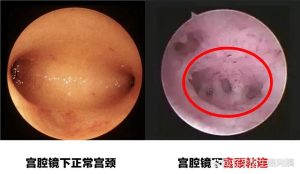 宫腔粘连会影响怀孕吗?术后多久能备孕?-两性知识丨两性健康--你想了解的我都知道