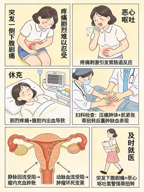 卵巢囊肿扭转有什么症状