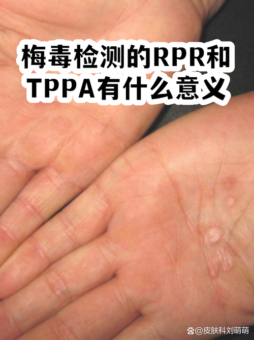 梅毒筛查RPR和TPPA怎么区分
