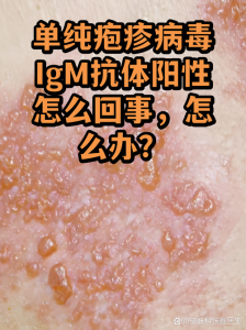 查出单纯疱疹病毒IgG阳性,到底要不要紧?-两性知识丨两性健康--你想了解的我都知道