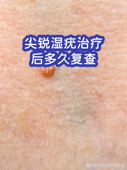 尖锐湿疣治疗后多久复查