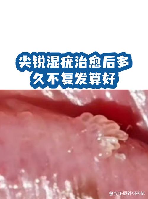 尖锐湿疣治疗后多久复查