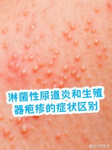 淋病和尿道炎是一回事吗？别再傻傻分不清了-两性知识丨两性健康--你想了解的我都知道