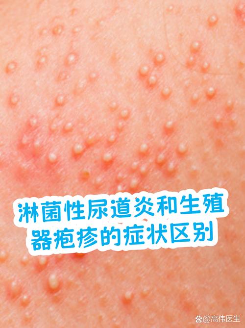 淋病和尿道炎是一回事吗