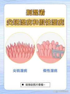 尖锐湿疣和假性湿疣到底怎么区分?一文教你快速辨别-两性知识丨两性健康--你想了解的我都知道
