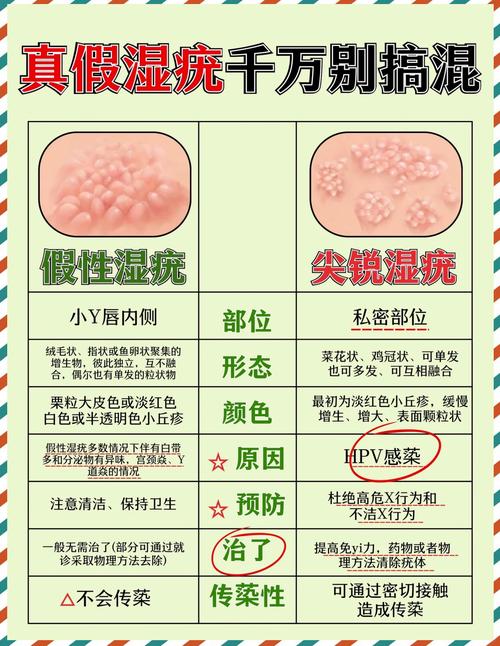 尖锐湿疣和假性湿疣区别