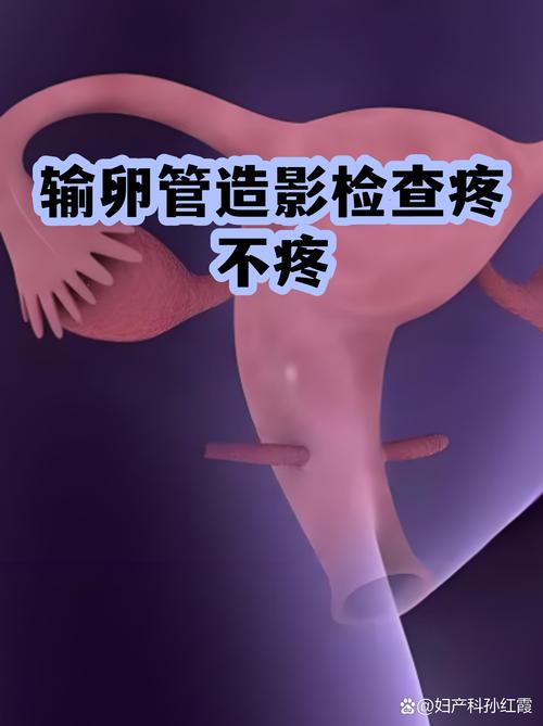 输卵管造影疼不疼