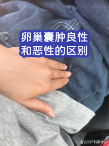 查出卵巢囊肿,到底该挂妇科还是肿瘤科?一文说清-两性知识丨两性健康--你想了解的我都知道