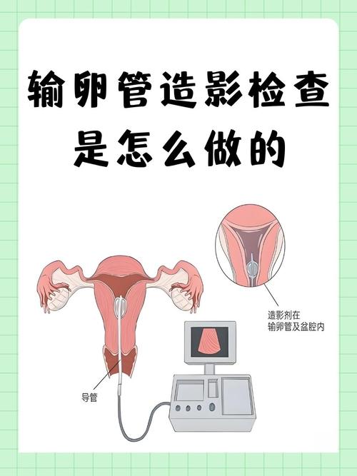 输卵管检查有哪些方式