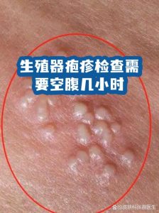 检查性病要空腹吗-两性知识丨两性健康--你想了解的我都知道