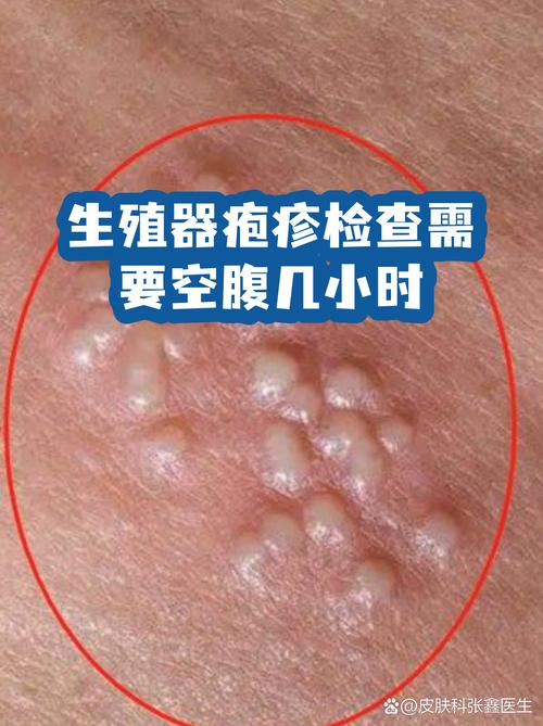 检查性病要空腹吗