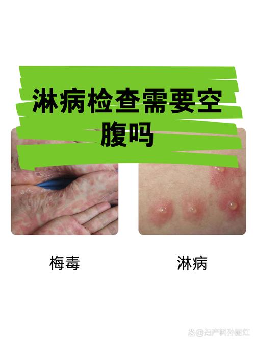 检查性病要空腹吗