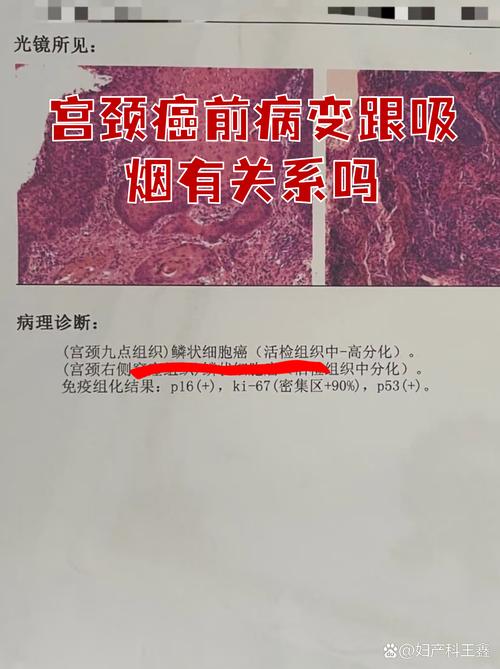 吸烟和宫颈病变有关系吗