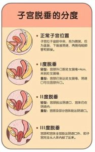 子宫脱垂会影响夫妻生活吗?别慌,听我慢慢说-两性知识丨两性健康--你想了解的我都知道