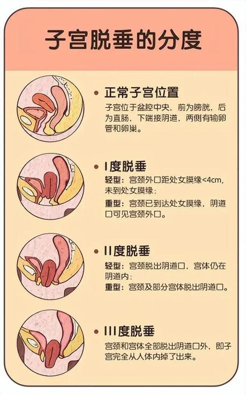 子宫脱垂影响性生活吗