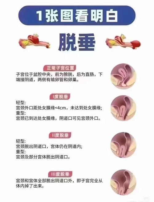 子宫脱垂影响性生活吗