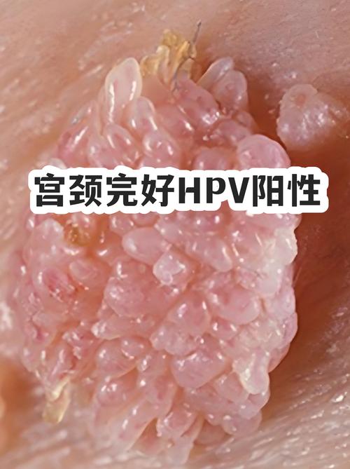 HPV阳性需要夫妻同治吗