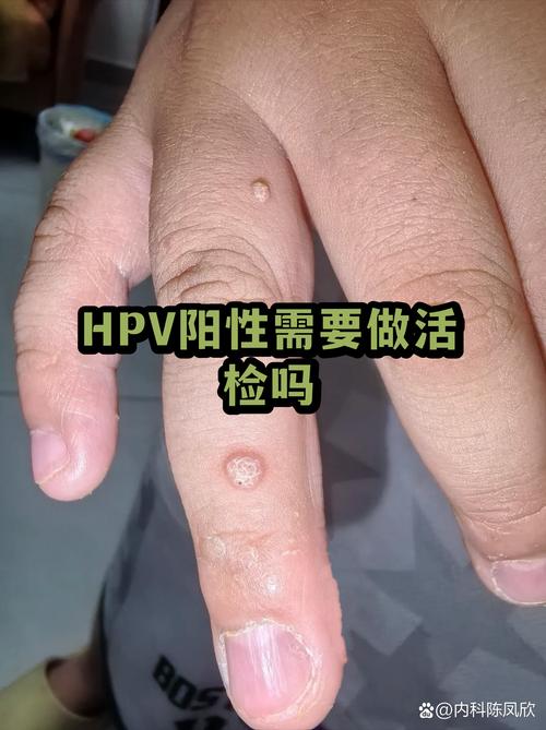 HPV阳性需要夫妻同治吗