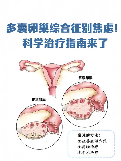 多囊和压力大有关系吗