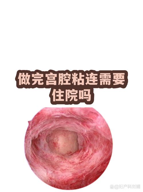 做宫腔镜需要住院吗
