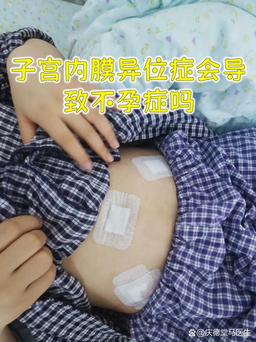 子宫内膜异位症会不孕吗