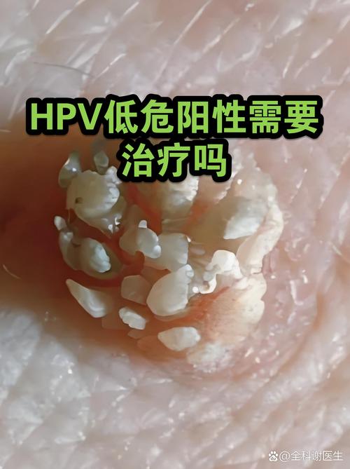 HPV阳性需要治疗吗