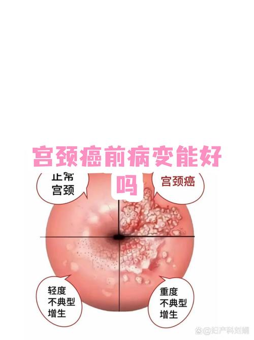 宫颈病变治疗会改变宫颈形态吗