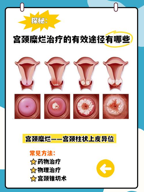 宫颈病变治疗会改变宫颈形态吗