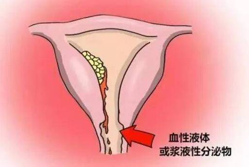 绝经后阴道排液要警惕吗
