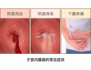 绝经后阴道排液要警惕吗？-两性知识丨两性健康--你想了解的我都知道
