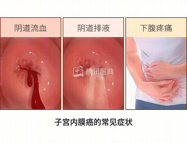 绝经后阴道排液要警惕吗
