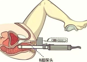 前列腺穿刺活检疼不疼-两性知识丨两性健康--你想了解的我都知道