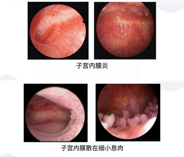 外阴肿块要做活检吗