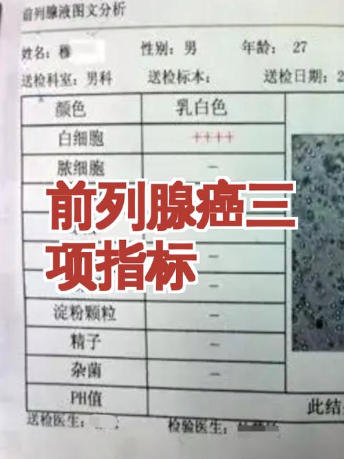 前列腺癌术后要复查哪些指标