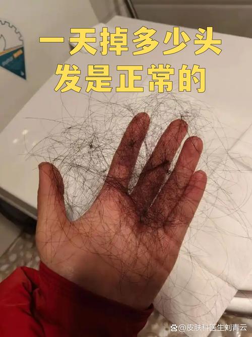 每天掉多少头发算正常