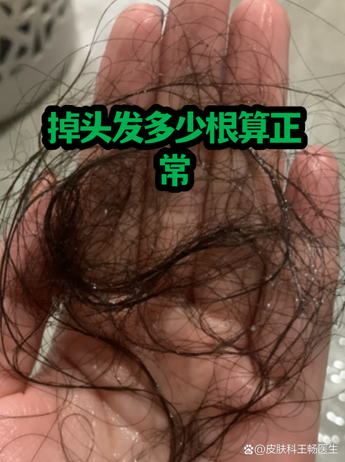 每天掉多少头发算正常