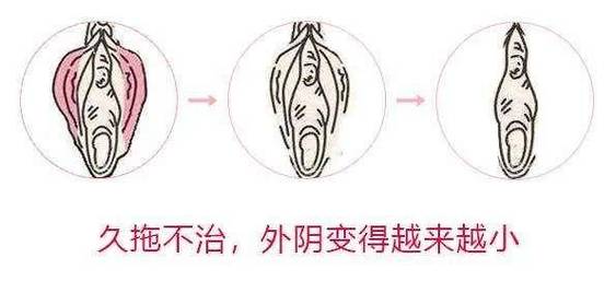 外阴瘙痒久治不愈要警惕吗