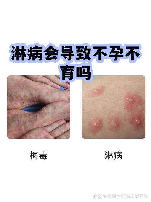 性传播感染会影响生育吗