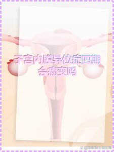 子宫内膜异位症真的会变成癌吗-两性知识丨两性健康--你想了解的我都知道