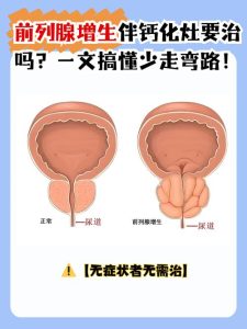 体检查出前列腺钙化灶,到底要不要治疗?-两性知识丨两性健康--你想了解的我都知道