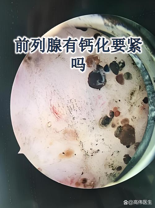 前列腺钙化灶，需要治疗吗