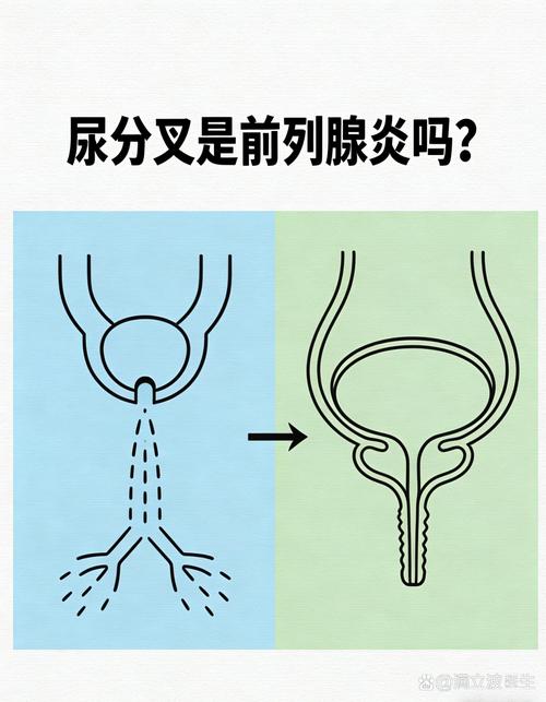 排尿分叉,是前列腺出问题了吗