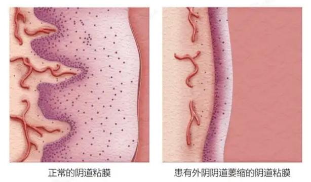 性欲低和阴道萎缩有关吗