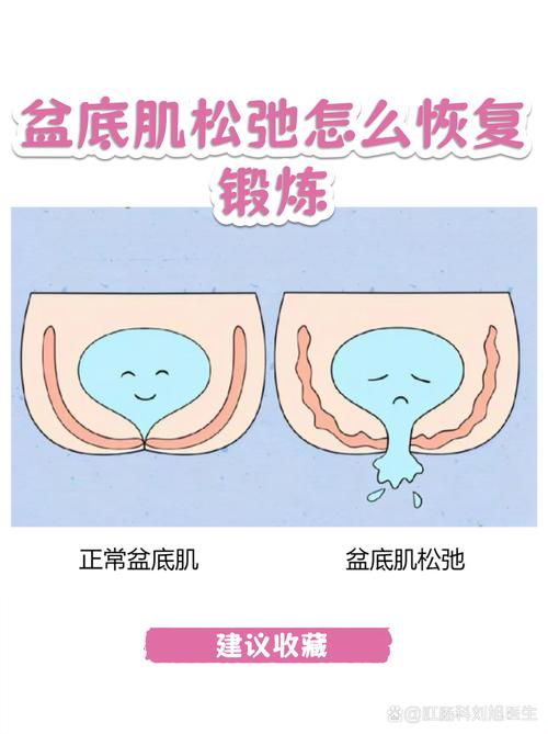 盆底肌松弛有哪些表现
