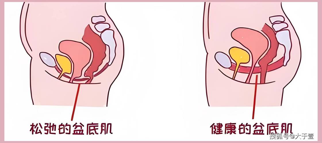 阴道松弛和盆底有关吗