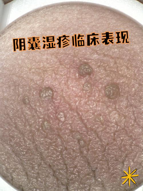 阴囊潮湿反复,是炎症还是皮肤问题