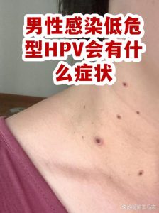 男性HPV感染会有什么症状-两性知识丨两性健康--你想了解的我都知道