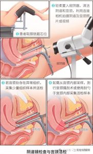 阴道镜活检究竟能不能查出宫颈癌?-两性知识丨两性健康--你想了解的我都知道
